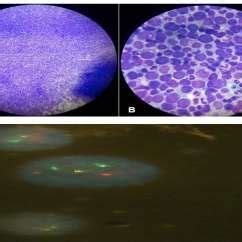 A Bone Marrow Aspirate Showing Hypercellularity With The Lower