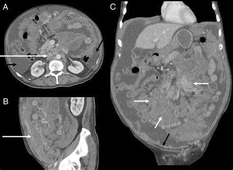 Peritoneal Lymphomatosis A Rare Presentation Of Follicular Lymphoma Mimicking Peritoneal