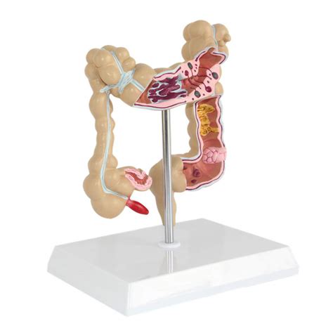 Buy Amhuui Human Colorectal Lesion Model Human Body Anatomy Replica Of