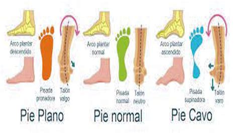 Consejos De Fisioterapia Para Tratar El Pie Cavo Ejercicios Efectivos