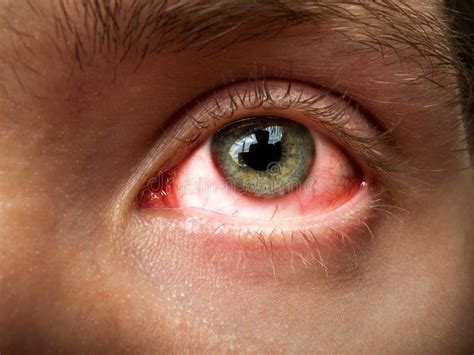 Conjunctivitis Conjunctival Inflammation Red Eyes Infection And