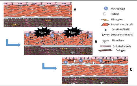 Figure From Targeting Smad Mediated Tgf Pathway In Coronary Artery