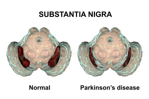 Substantia Nigra In Norm And In Parkinson`s Disease Stock Illustration Illustration Of Neurone