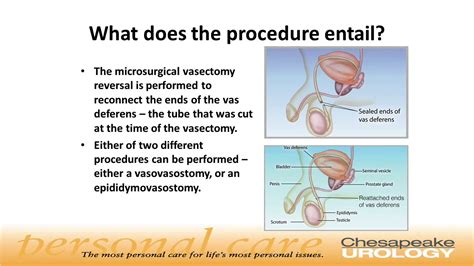 Microsurgery Vasectomy Reversal Chesapeake Urology Youtube