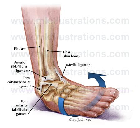 What to Do If You Sprain Your Ankle | CompletePT Pool & Land Physical Therapy