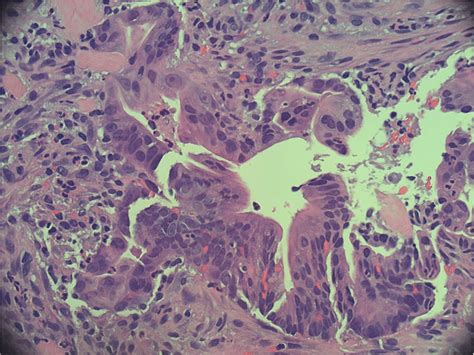 Hematoxylin Eosin Stain At 40x Magnification Tumor Fragment With Download Scientific Diagram