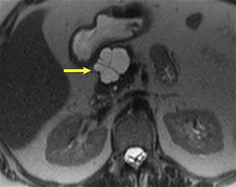 Incidental Pancreatic Cysts On Cross Sectional Imaging Radiology Key