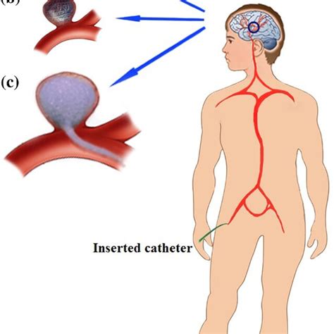 The Variety Of Treatment For Cerebral Aneurysms A Clipping B Coiling