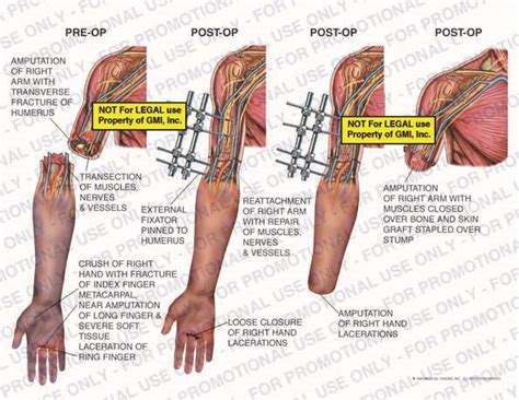 Progressive Amputation And Attempted Reattachment Of Right Arm