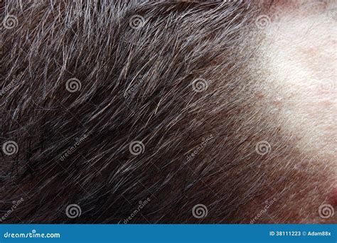 Loss Of Hair From The Head Stock Image Image Of Allergy 38111223