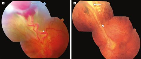 Three Cases Of Large Retinal Capillary Hemangiomas Treated With Verteporfin And Photodynamic