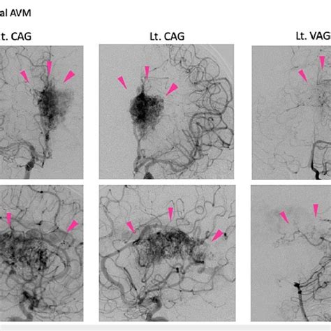 Preoperative Angiography Right Cerebral Angiography Rt CAG Left