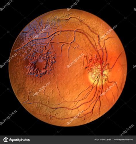 Proliferative Diabetic Retinopathy Illustration Showing