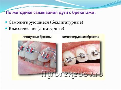 Назначение брекет-системы - презентация онлайн