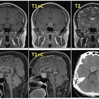 Dynamic Contrast MRI Pre Operative Yellow Arrowhead Normal