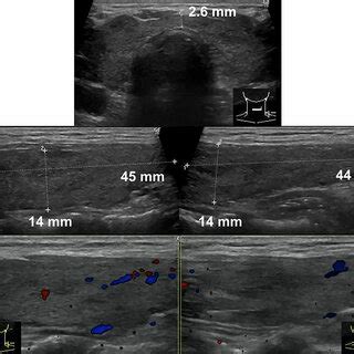 Figure2.Thyroid echography shows a heterogeneous thyroid of normal size ...