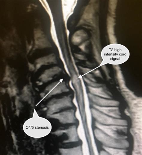 Cervical Spine Ct Scan