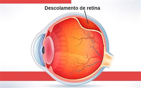 Retina e Vítreo