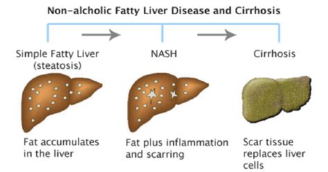 Fatty Liver Disease: 6 Symptoms You Need to Know