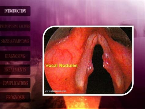 Vocal nodules