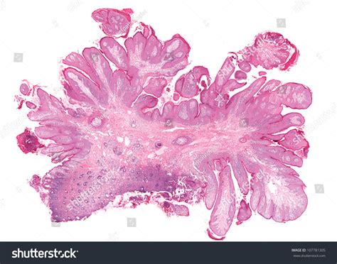 Cutaneous Benign Squamous Papilloma Skin Wart Stock Photo 107781305