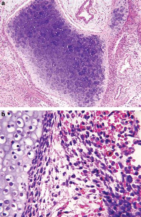 The Nodules Of Cartilage Varied In Size And Degree Of Cellularity A