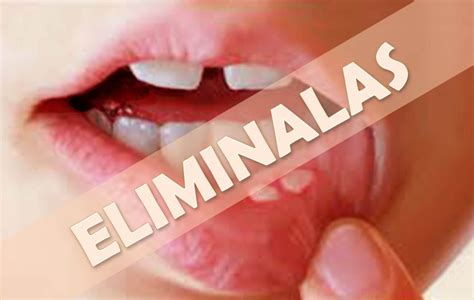 Como Combatir El Herpes Labial O Aftas Bucales Con Estos Secretos