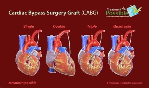 Heart Bypass Surgery Treatment Possible