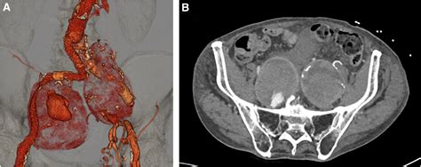 Internal Iliac Artery Aneurysm In A Patient With Proximal Occlusion At