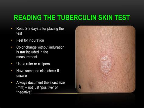 Ppt Tuberculin Skin Testing Mantoux Tuberculin Skin Test Powerpoint