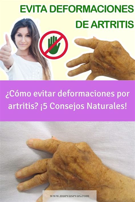 Descubre 5 Consejos Naturales Para Evitar Las Deformaciones Por Artritis Conoce Cómo Se