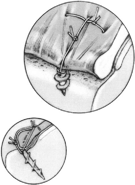 Figure 1 From A Modified Mason Allen Technique For Rotator Cuff Repair