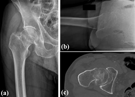 The Influence Of The Ct Scan In The Evaluation And Treatment Of