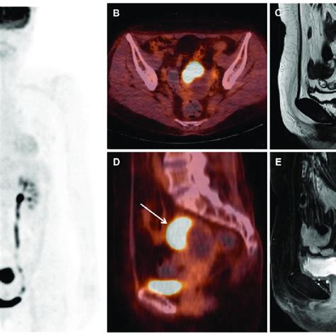 A 67 Year Old Postmenopausal Woman Who Presented With Vaginal Bleeding