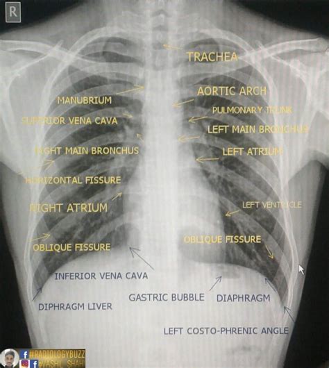 ray shows  chest  ribs  labels   ribcage