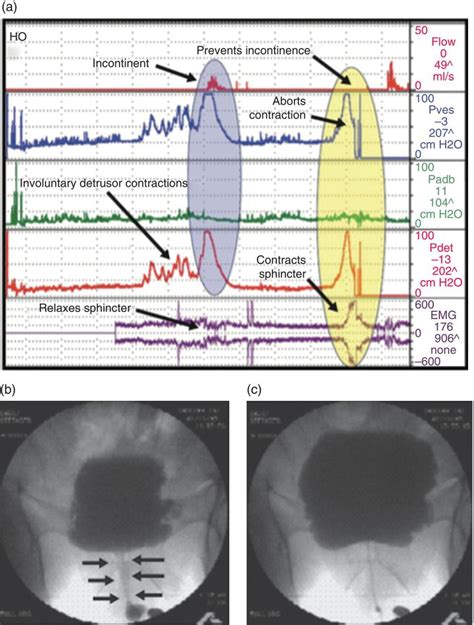 Male Lower Urinary Tract Symptoms And Assessment Abdominal Key