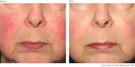 Ipl Treatment For Rosacea Lumenis