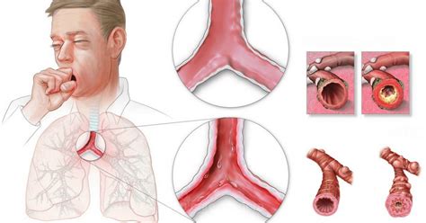 Doença Pulmonar Obstrutiva Crônica Dpoc