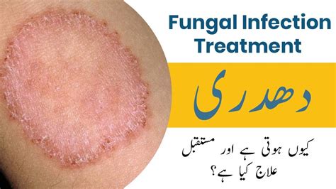 Fungal Infection Treatment In Urdu Hindi Dadri Ka Ilaj In Urdu Hindi