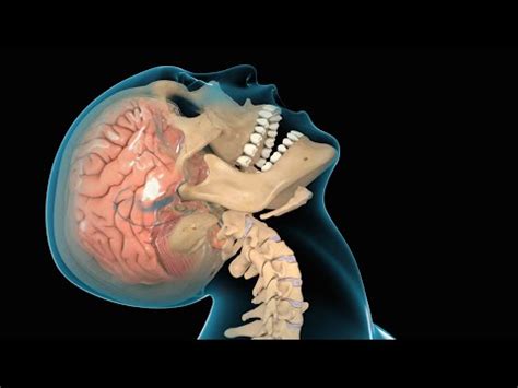 Concussion Traumatic Brain Injury Tbi Youtube