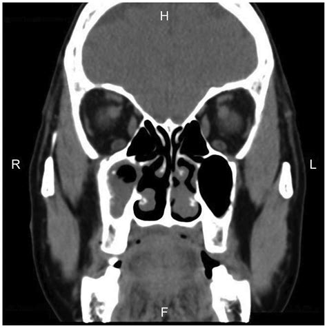 Accessory Maxillary Sinus Ostia In Superior Meatus A Retrospective