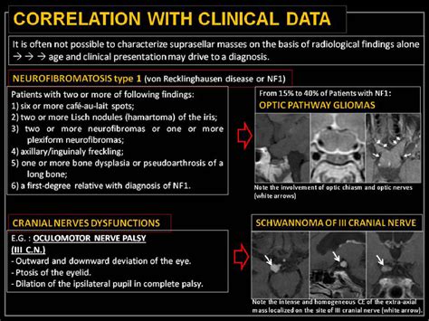 Figure 2 From Imaging Of Pure Suprasellar Lesions Semantic Scholar