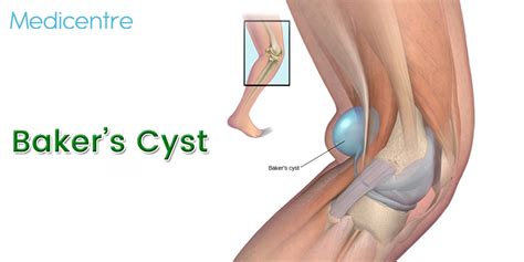 Bakers Cyst Causes Symptoms And Treatments