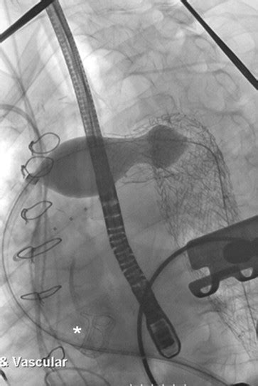 Transapical Endovascular Aortic Repair To Treat Complex Aortic