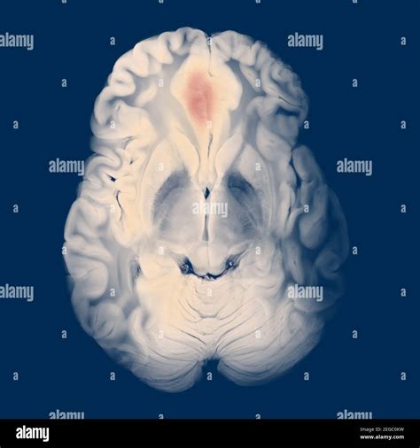 Lobes Of Brain Axial