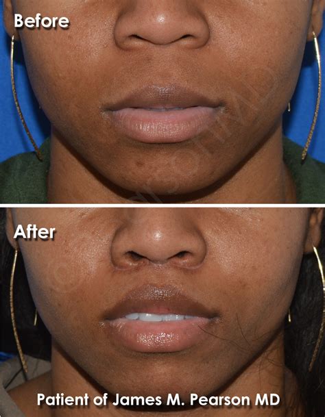 Lip Lift Photos Before After Dr James Pearson Facial Plastic Surgery