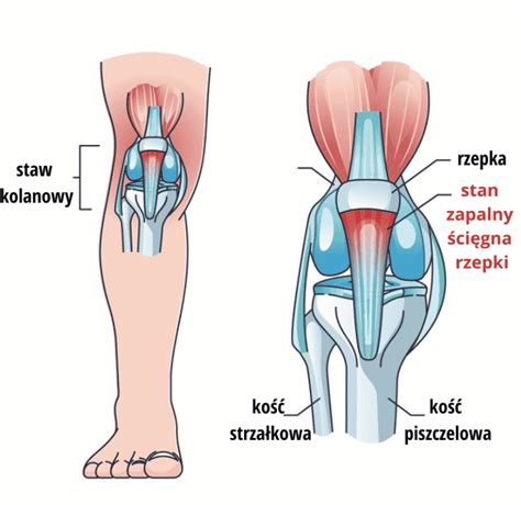 Kolano Skoczka Kogo Dotyczy I Jak Przebiega Leczenie