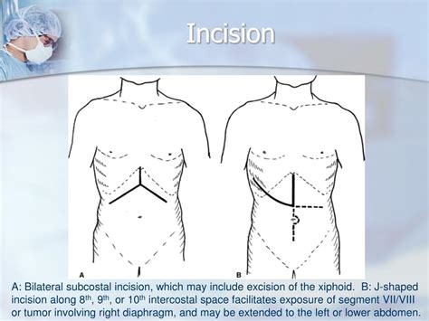 Ppt Liver Resection Powerpoint Presentation Free Download Id 2809783