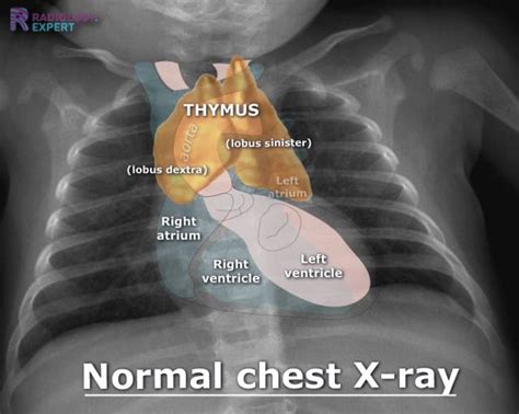 Normal Chest X Ray Labeled