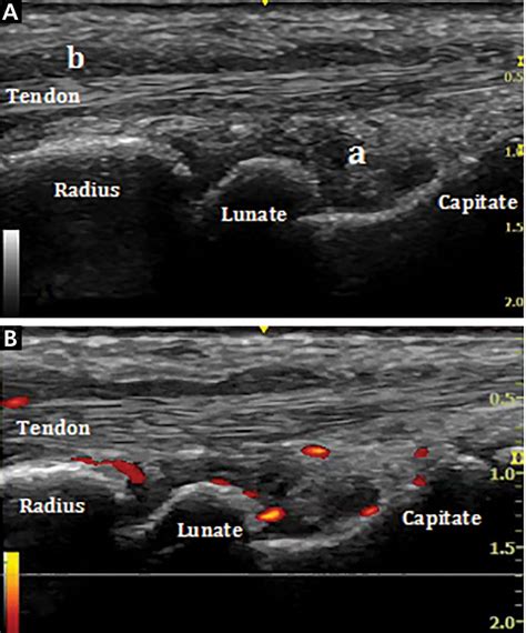 Musculoskeletal Ultrasonography Has Arrived Cleveland Clinic Journal